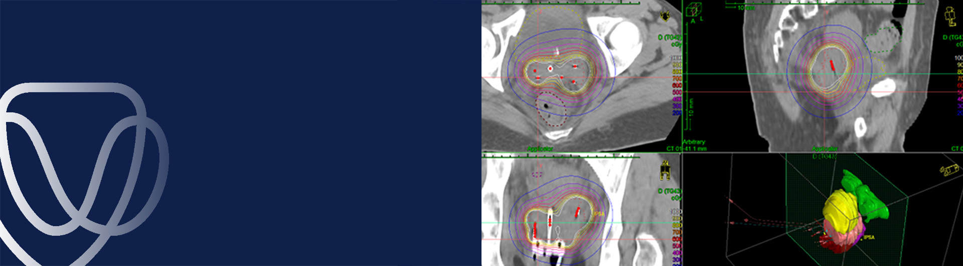 Brachytherapy for cervical cancer